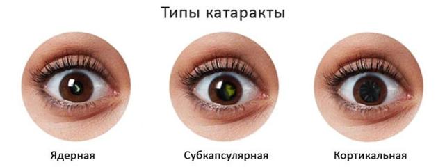 Катаракта - причины, симптомы, профилактика и лечение без операции в Москве