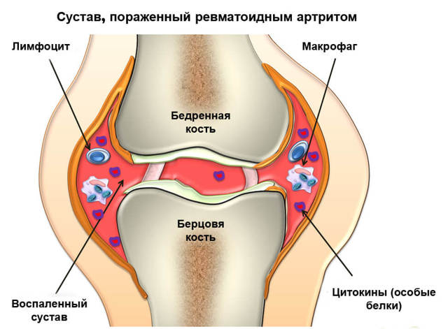 Лекарства последнего поколения для лечения ревматоидного артрита