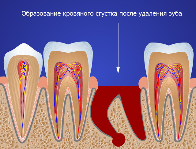 Болит десна после удаления зуба – как быть и что делать