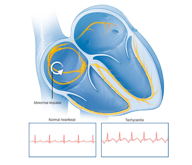 Сильное сердцебиение: причины, что делать