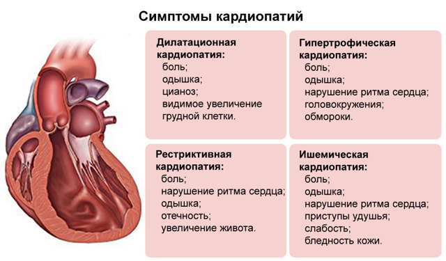 Кардиомиопатия сердца: симптомы и лечение