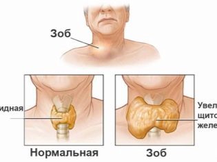 Свечи и мазь Релиф при беременности от геморроя: инструкция, применение Релиф Ультра, Про, Адванс