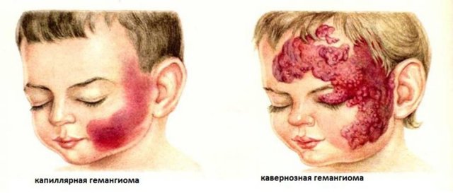 Гемангиома у новорожденных детей: причины возникновения, лечение, последствия