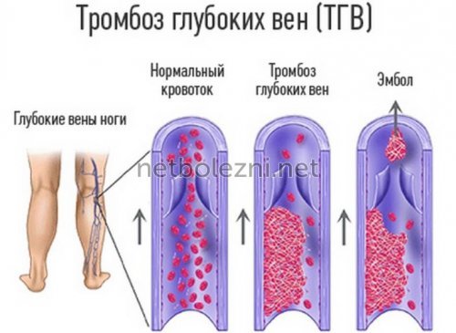 Антикоагулянты – механизм действия, список препаратов