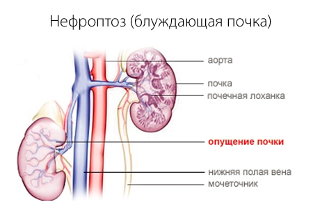 Нефроптоз почек - причины, симптомы, лечение и диета