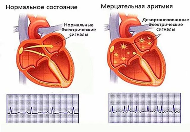 Обезболивающие при атеросклерозе сосудов нижних конечностей
