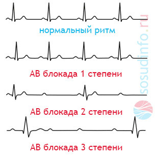 Что такое ав блокада сердца