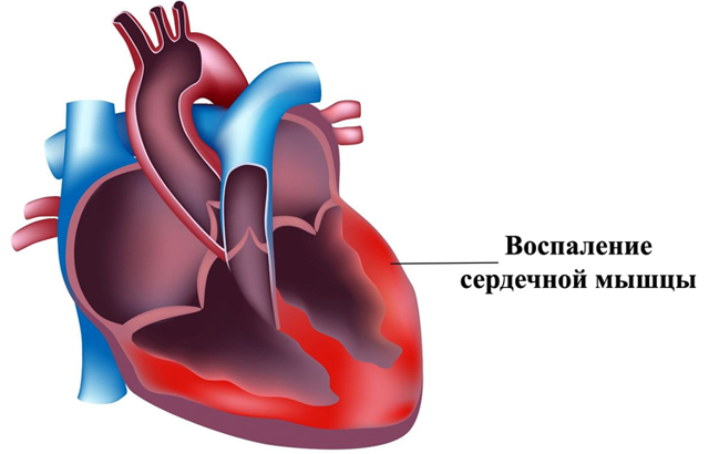Аллергический миокардит у детей и взрослых: симптомы, лечение