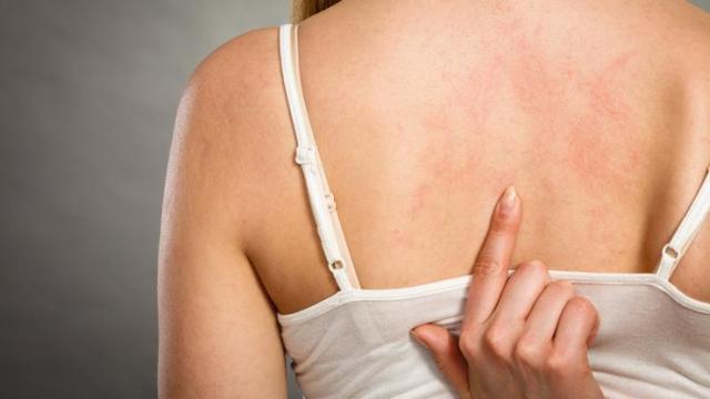 Аллергия после приема антибиотиков лечение — Аллергия