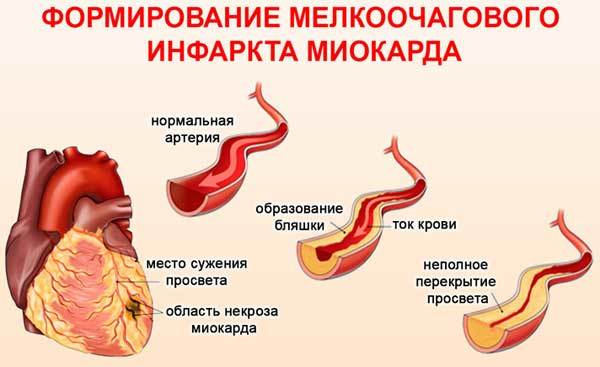 Инфаркт миокарда на ЭКГ: признаки, расшифровка