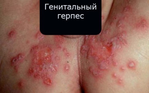 Генитальный герпес - фото проявлений у мужчин и женщин
