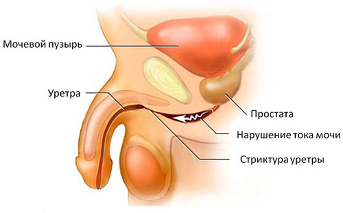 Жжение, боль и рези при мочеиспускании у мужчин и женщин: причины и лечение