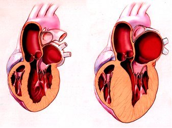 Нагрузка на левое предсердие - Все про гипертонию