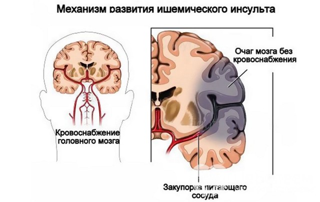 Что такое ишемический инсульт: причины, формы, симптомы, лечение