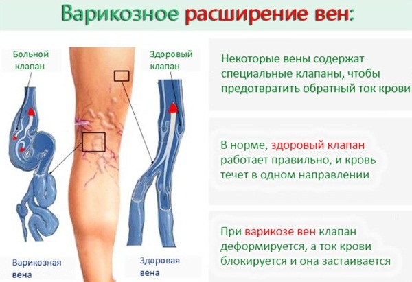 Сколько пить детралекс при варикозе на сайте варикоз