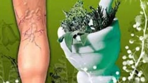 Народные средства для эффективного лечения варикоза вен на ногах