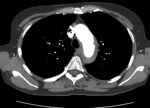 Аорта развернута что это значит. Аорта уплотнена и развернута что это