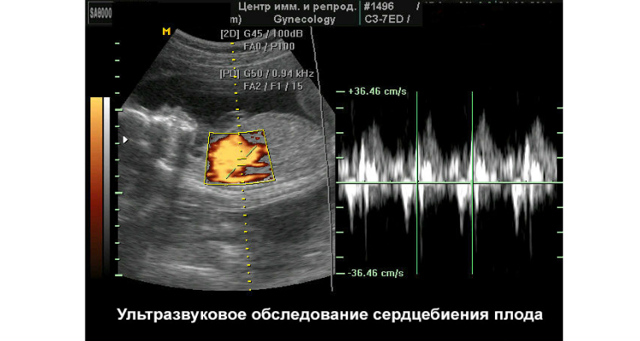 Как определить пол удущего ребенка по сердцебиению - прогнозы