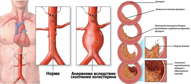 Симптомы стеноз брюшной аорты - Про холестерин