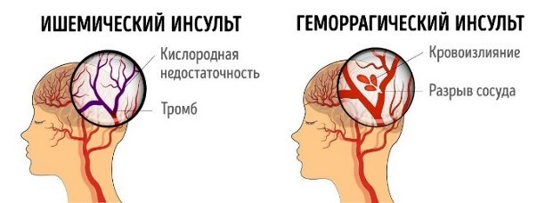Жизнь после инсульта