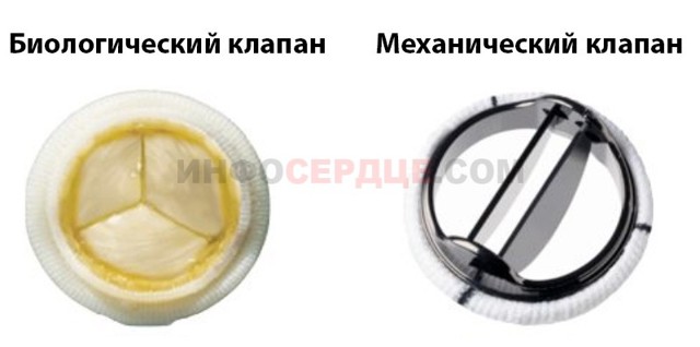 Трикуспидальная регургитация: степени, причины, лечение. Минимальная митральная регургитация что это такое