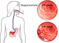 Гастрит — симптомы и лечение - симптомы, диагностика, лечение, профилактика