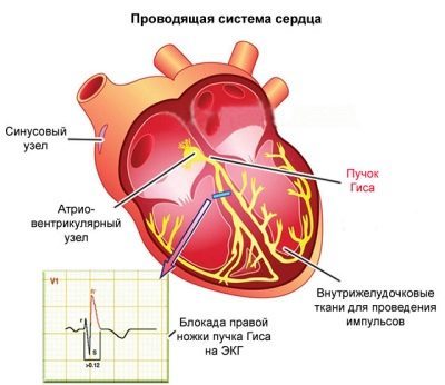 Неполная блокада правой ножки пучка Гиса