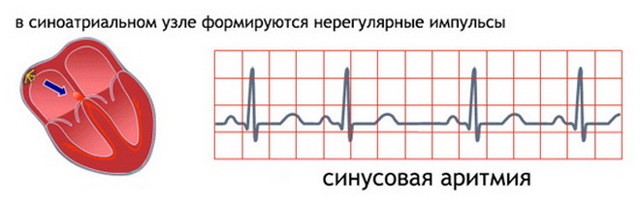 Регулярный и нерегулярный синусовый ритм сердца