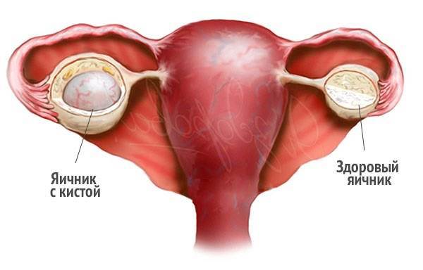 Киста яичника у женщин – причины, признаки и симптомы кисты левого и правого яичника у женщин. Последствия и разрыв кисты