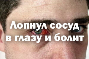Почему лопаются сосуды в глазах? Причины и лечение
