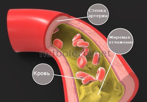 Лекарство для снижения холестерина без побочных эффектов - Про холестерин