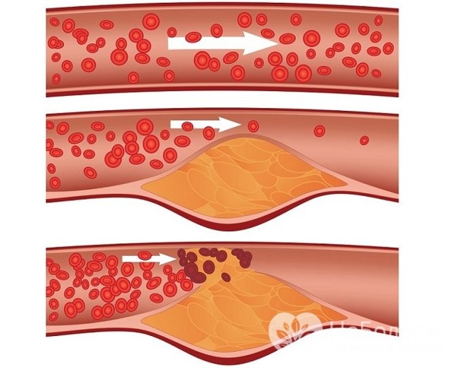 От чего происходит инфаркт миокарда