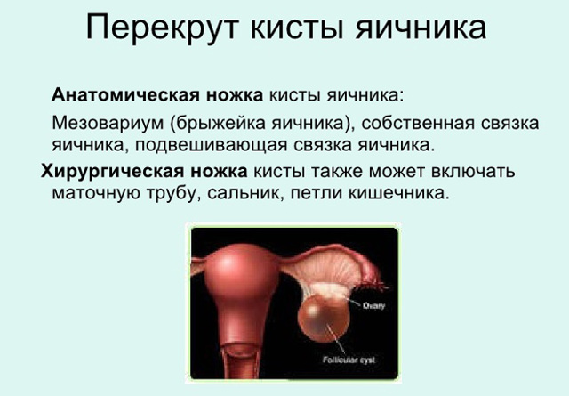 Фолликулярная киста яичника - симптомы, лечение, причины