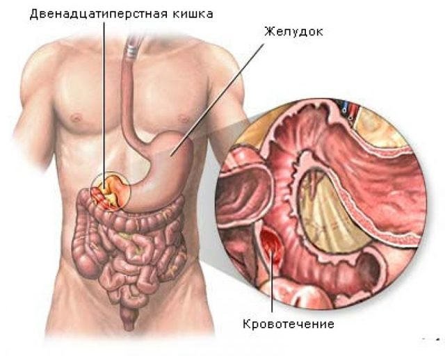 Неотложная помощь при желудочном кровотечении
