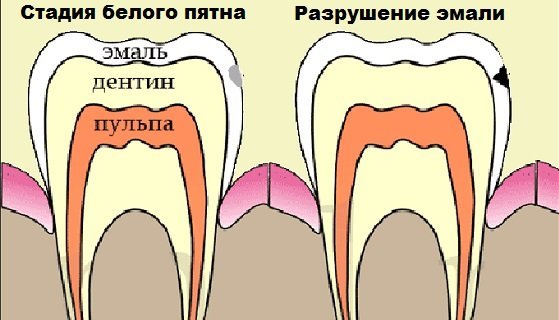 Поверхностный кариес - причины, симптомы и лечение