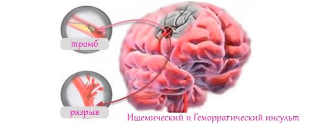 Инсульт: симптомы и первые признаки у женщин и мужчин, первая помощь и лечение