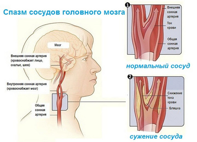 Спазм сосудов головного мозга: симптомы и причины