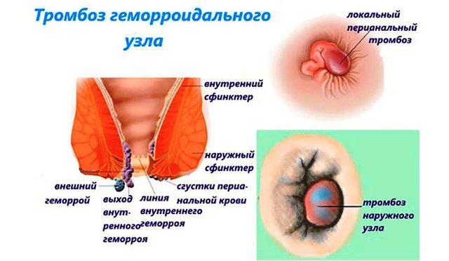 Лечение геморроя без операции: эффективные методы
