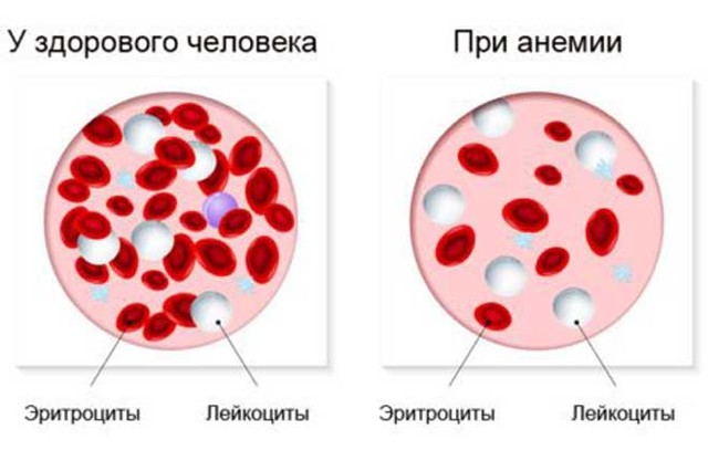 Мснс в анализе крови понижен причины
