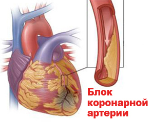 Классификация инфаркта миокарда: основные виды, формы и стадии