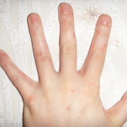 Лечение псориаз на руках - фото, симптомы, виды псориаза на руках