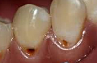 Пришеечный кариес - причины, симптомы, диагностика и лечение