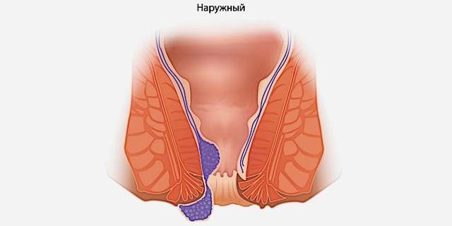 Что нужно делать если геморрой вылез наружу и болит