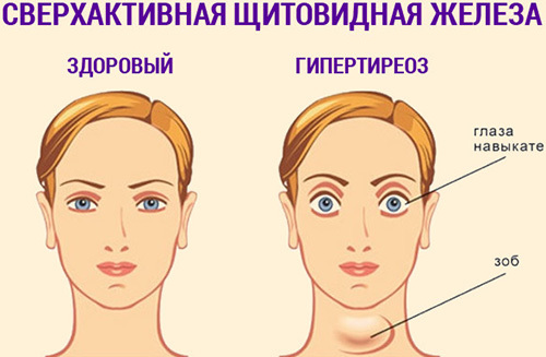 Гипертиреоз - причины, симптомы, диагностика и лечение