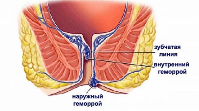 Мазь от геморроя состав плюсы отзывы цены рекомендации
