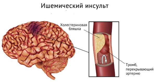 Высокое сердечное давление: причины, симптомы и лечение