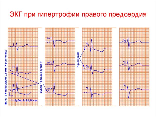 Гипертрофия правого предсердия на ЭКГ: симптомы перегрузки сердца