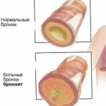 Не проходит влажный кашель