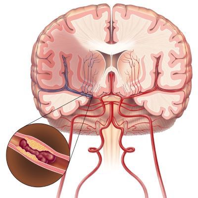 Ишемический инсульт - причины, симптомы, диагностика и лечение