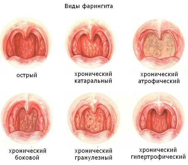 Фарингит – острый и хронический. Симптомы и лечение фарингита.